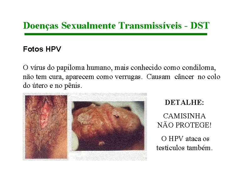 Doenças Sexualmente Transmissíveis - DST Fotos HPV O vírus do papiloma humano, mais conhecido