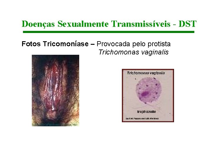Doenças Sexualmente Transmissíveis - DST Fotos Tricomoníase – Provocada pelo protista Trichomonas vaginalis 