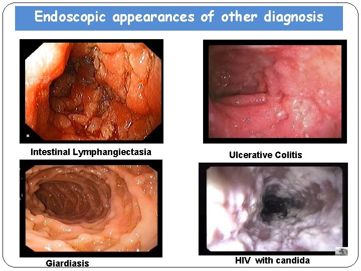 Giardiasis endoscopy