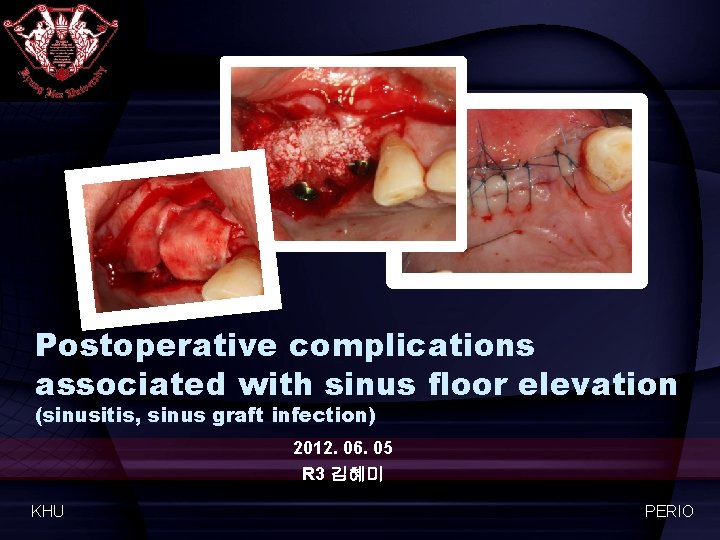 Postoperative complications associated with sinus floor elevation (sinusitis, sinus graft infection) 2012. 06. 05