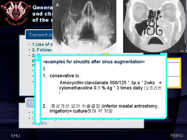 General guidelines for the treatment of transient and chronic maxillary sinusitis after augmentation of