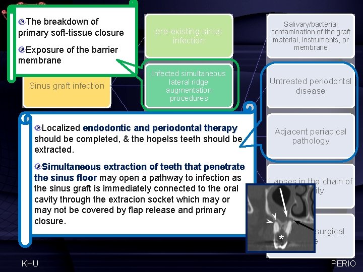 The breakdown of primary soft-tissue closure Exposure of the barrier membrane Sinus graft infection