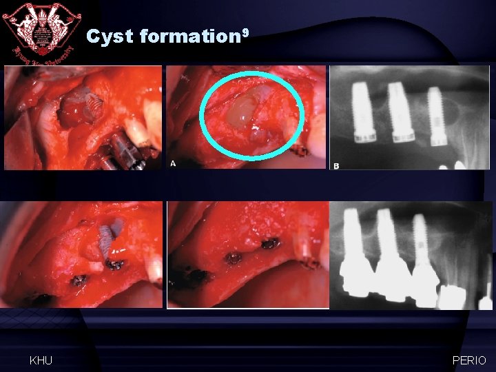 Cyst formation 9 KHU PERIO 