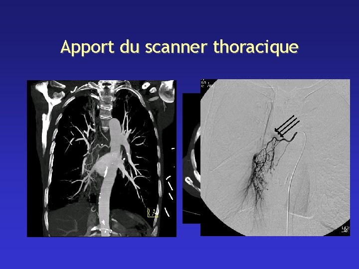 Apport du scanner thoracique 