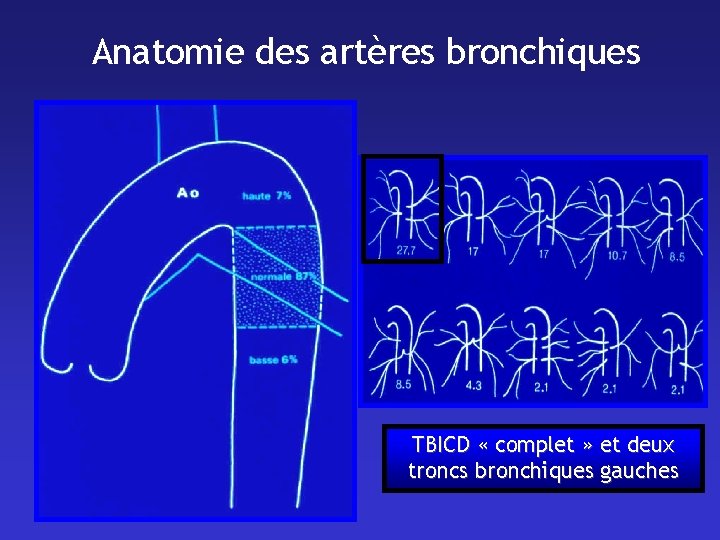 Anatomie des artères bronchiques TBICD « complet » et deux troncs bronchiques gauches 