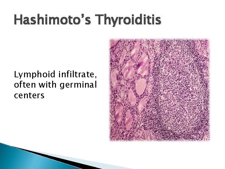 Hashimoto’s Thyroiditis Lymphoid infiltrate, often with germinal centers 