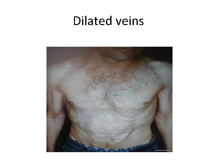 Dilated veins 
