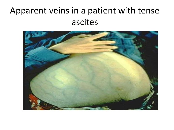 Apparent veins in a patient with tense ascites 