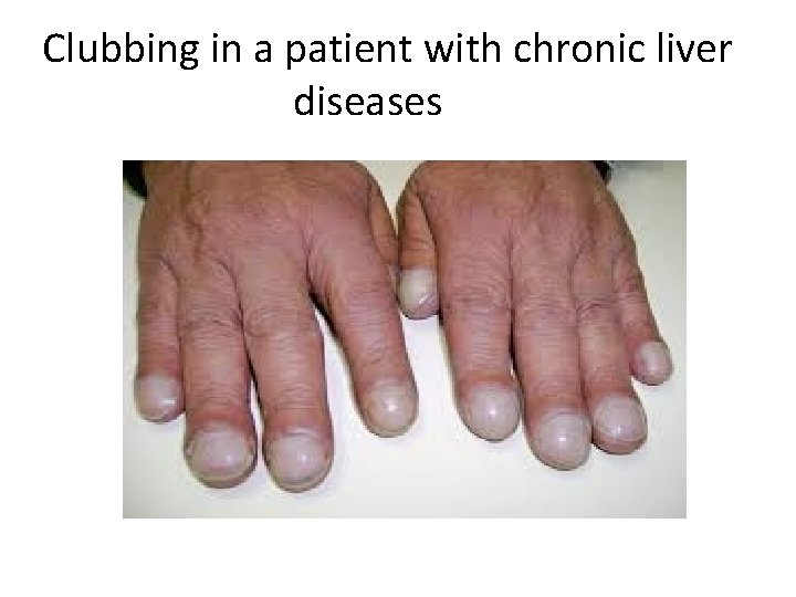 Clubbing in a patient with chronic liver diseases 