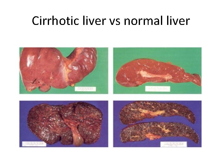 Cirrhotic liver vs normal liver 