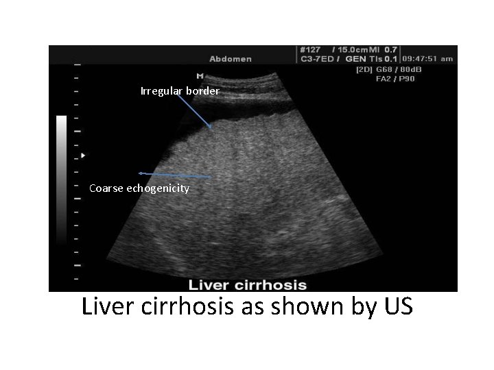 Irregular border Coarse echogenicity Liver cirrhosis as shown by US 