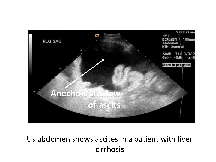 Anechoic shadow of ascits Us abdomen shows ascites in a patient with liver cirrhosis