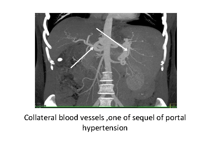 Collateral blood vessels , one of sequel of portal hypertension 