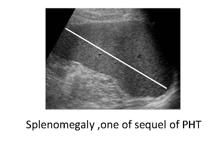 Splenomegaly , one of sequel of PHT 