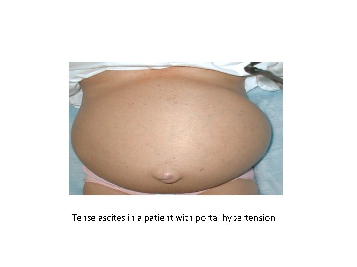 Tense ascites in a patient with portal hypertension 