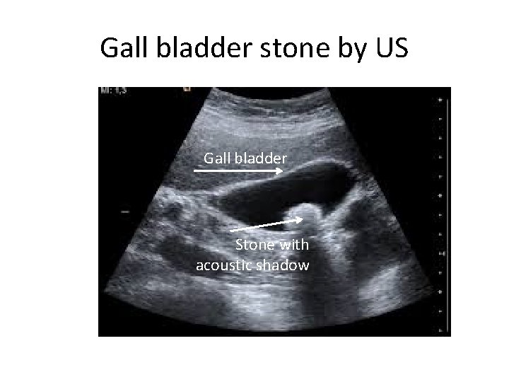 Gall bladder stone by US Gall bladder Stone with acoustic shadow 