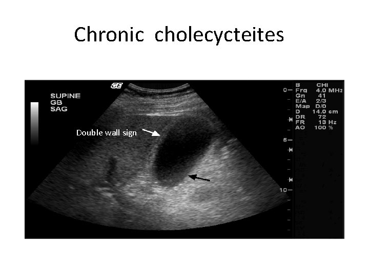 Chronic cholecycteites Double wall sign 