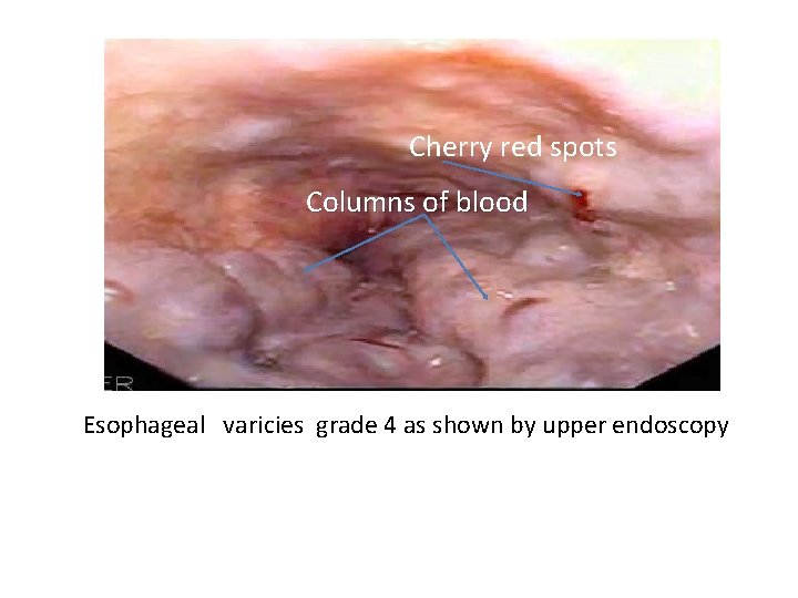 Cherry red spots Columns of blood Esophageal varicies grade 4 as shown by upper