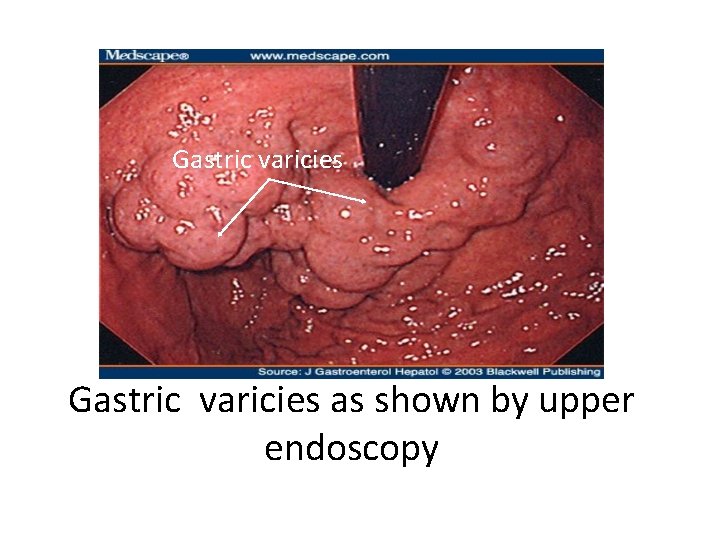 Gastric varicies as shown by upper endoscopy 