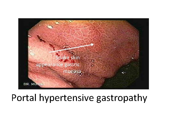 Snake skin appearance gastric mucosa Portal hypertensive gastropathy 