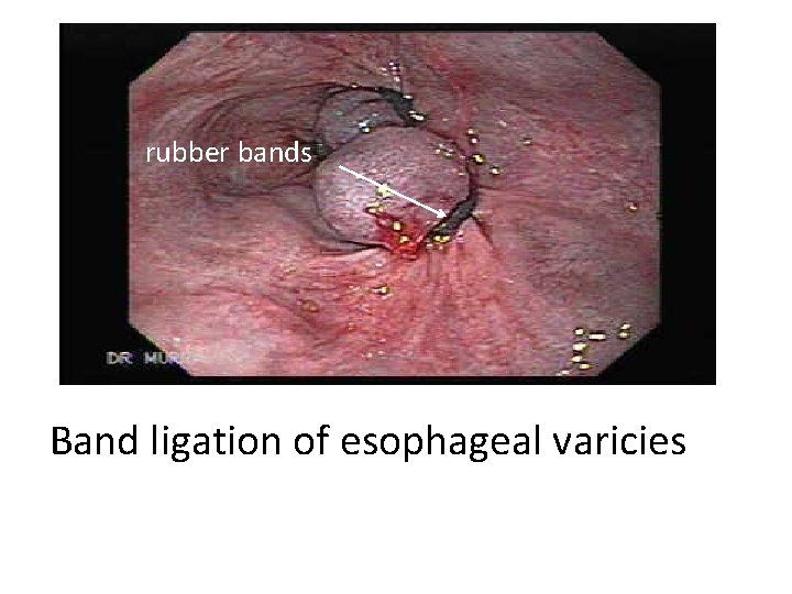 rubber bands Band ligation of esophageal varicies 