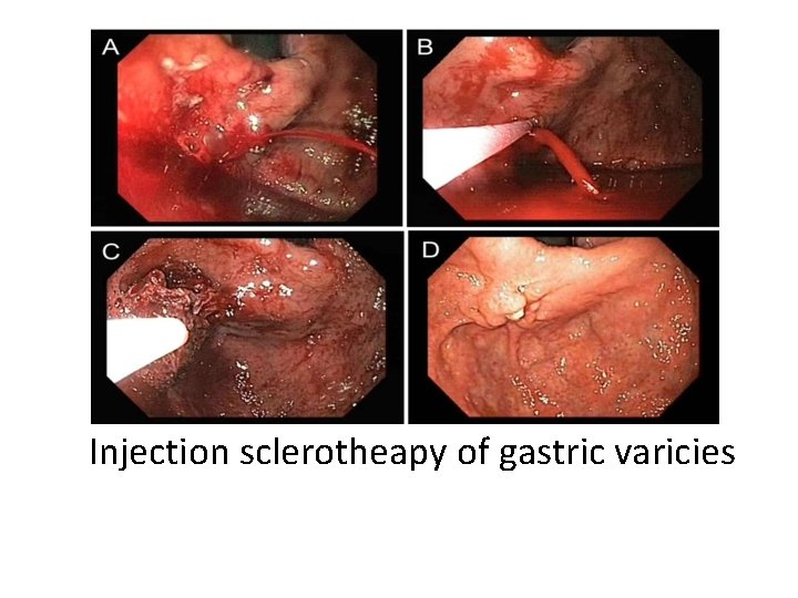 Injection sclerotheapy of gastric varicies 