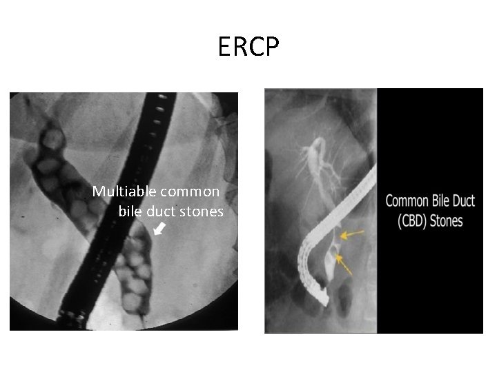 ERCP Multiable common bile duct stones 