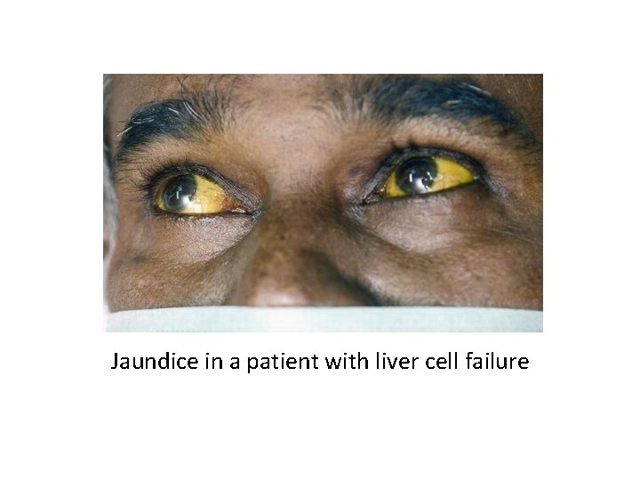 Jaundice in a patient with liver cell failure 