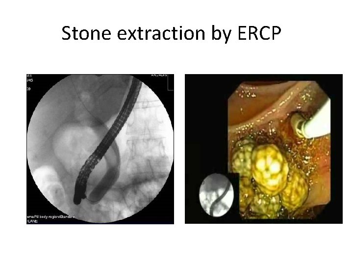 Stone extraction by ERCP 
