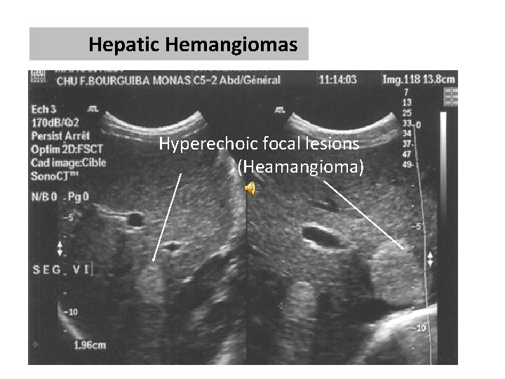 Hepatic Hemangiomas Hyperechoic focal lesions (Heamangioma) 