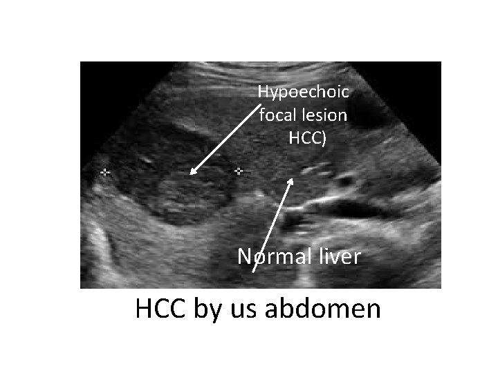 Hypoechoic focal lesion HCC) Normal liver HCC by us abdomen 