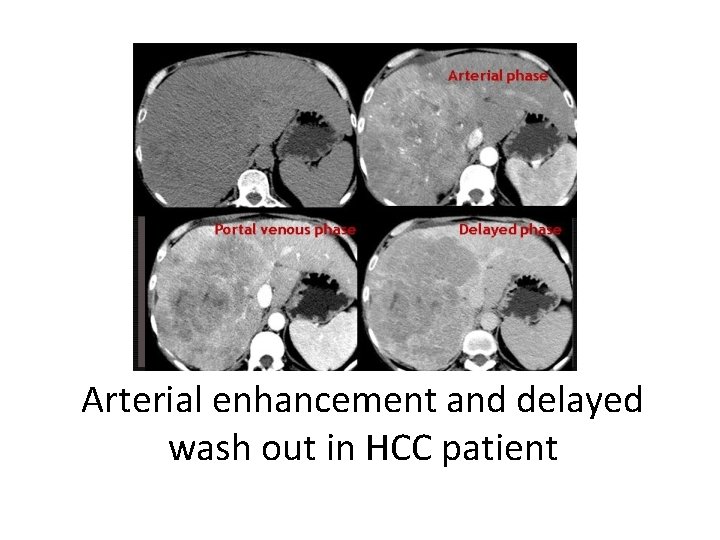 Arterial enhancement and delayed wash out in HCC patient 