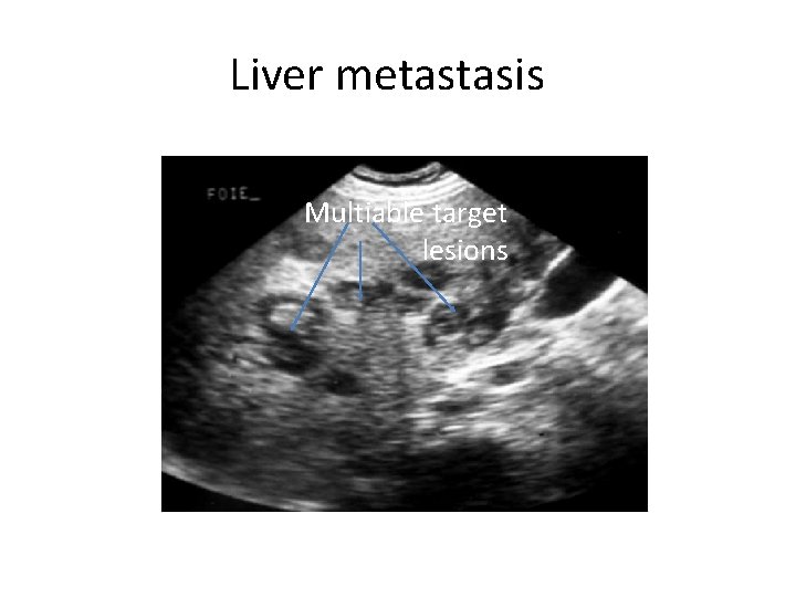 Liver metastasis Multiable target lesions 
