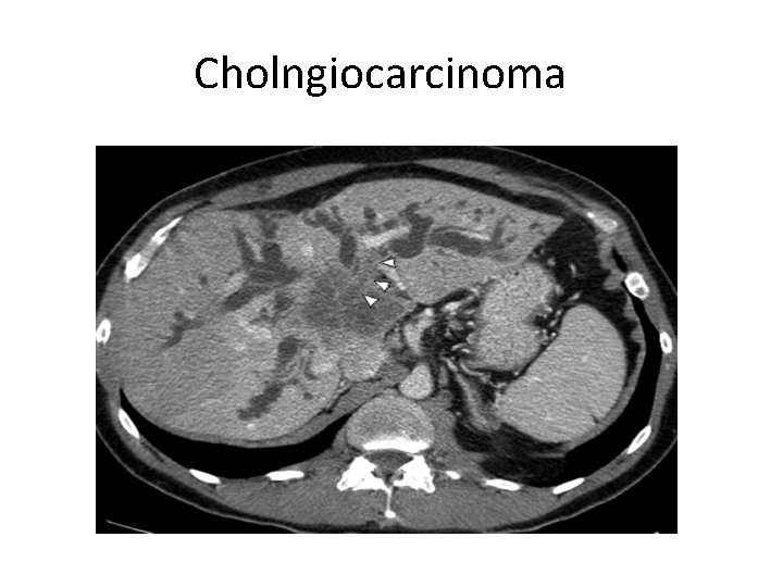 Cholngiocarcinoma 