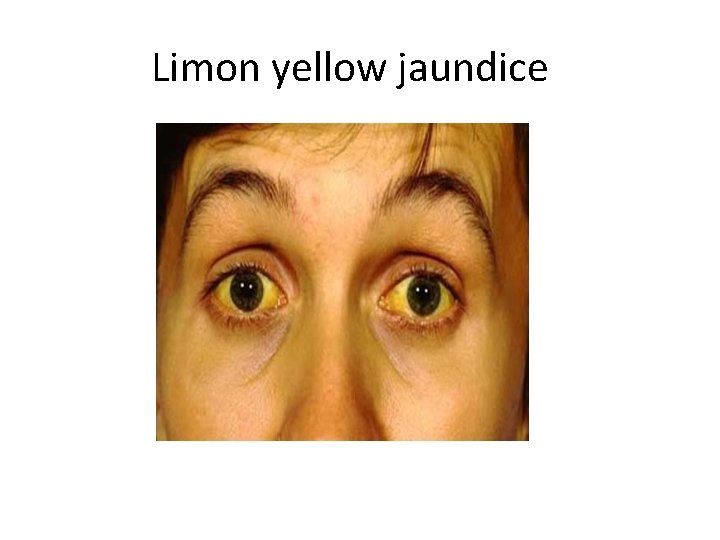 Limon yellow jaundice 