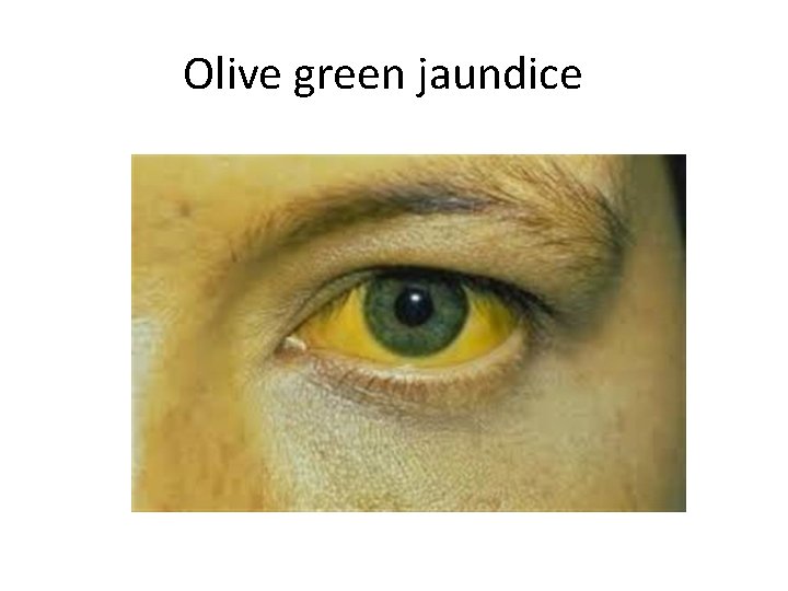 Olive green jaundice 