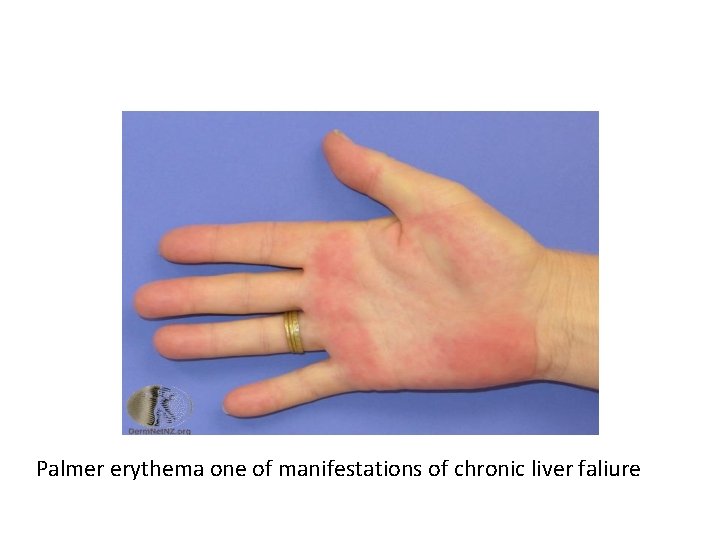 Palmer erythema one of manifestations of chronic liver faliure 