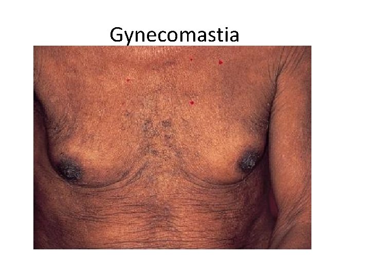 Gynecomastia 