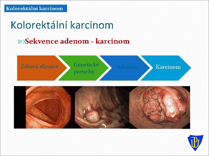 Kolorektální karcinom Sekvence adenom - karcinom Zdravá sliznice Genetické poruchy Adenom Karcinom Kolorektální karcinom Sekvence adenom - karcinom Zdravá sliznice Genetické poruchy Adenom Karcinom