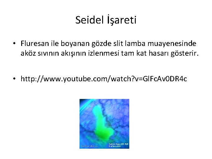 Seidel İşareti • Fluresan ile boyanan gözde slit lamba muayenesinde aköz sıvının akışının izlenmesi