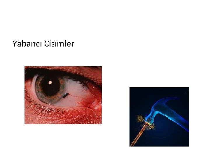 Yabancı Cisimler 