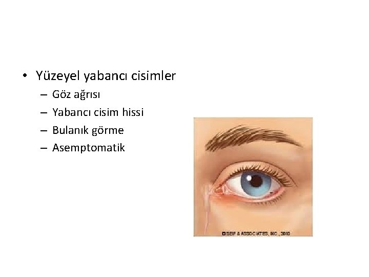  • Yüzeyel yabancı cisimler – – Göz ağrısı Yabancı cisim hissi Bulanık görme