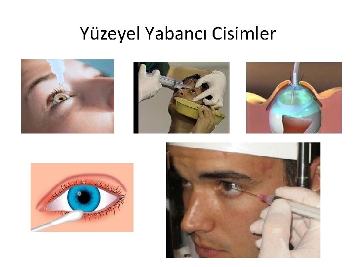Yüzeyel Yabancı Cisimler 