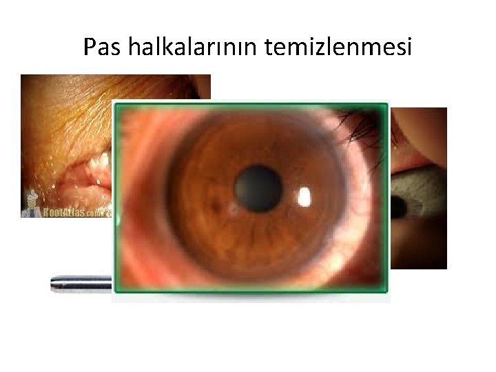 Pas halkalarının temizlenmesi 