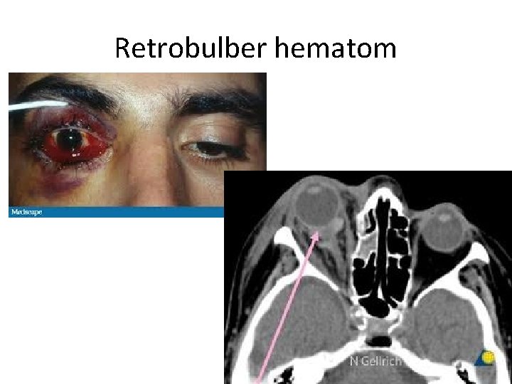 Retrobulber hematom 