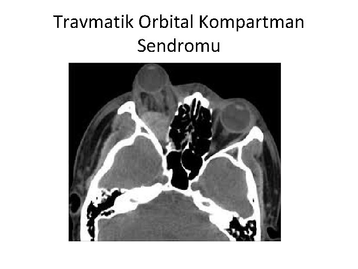 Travmatik Orbital Kompartman Sendromu 