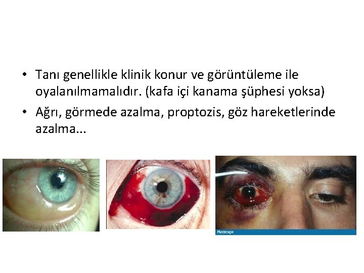  • Tanı genellikle klinik konur ve görüntüleme ile oyalanılmamalıdır. (kafa içi kanama şüphesi