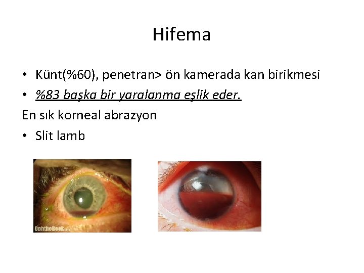 Hifema • Künt(%60), penetran> ön kamerada kan birikmesi • %83 başka bir yaralanma eşlik