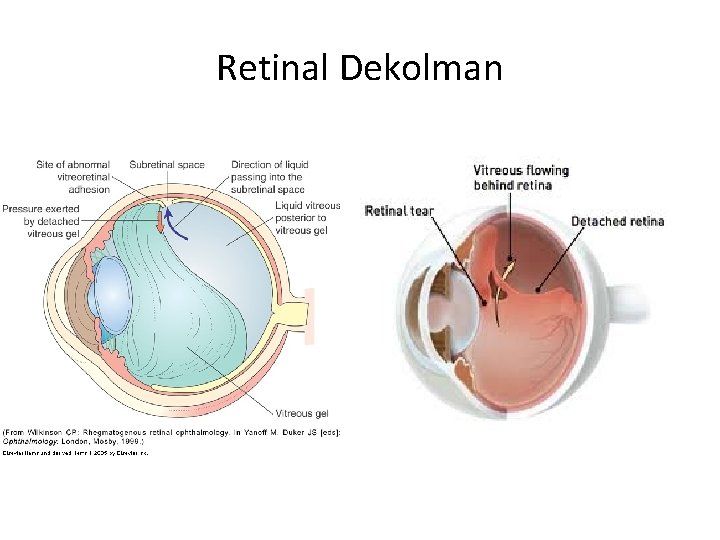 Retinal Dekolman 
