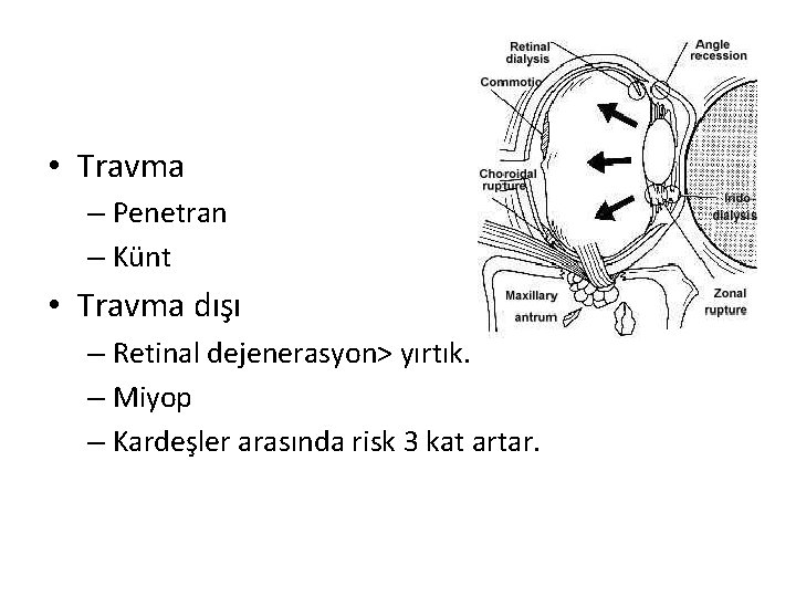  • Travma – Penetran – Künt • Travma dışı – Retinal dejenerasyon> yırtık.